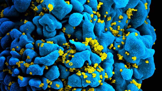"HIV-infected T cell" by NIAID licensed under CC BY 2.0